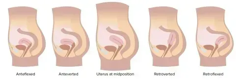 Anteverted Uterus