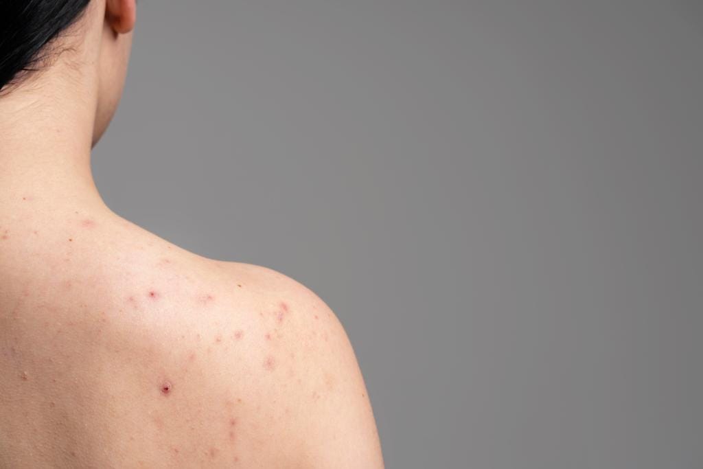 how can you get rid of body acne